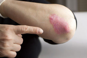 natural treatment of psoriasis