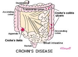 Signs and Symptoms of Crohn's Disease