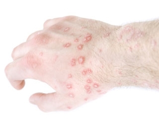 psoriasis treatment