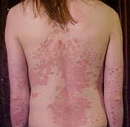 Natural treatment for Psoriasis