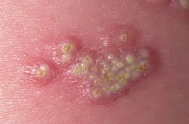 natural herpes treatment