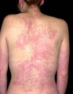 Natural treatment for hives