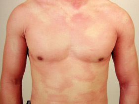 Physical urticaria