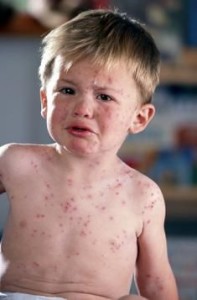 Hives in children