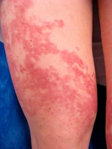 urticarial vasculitis symptoms