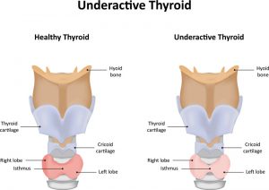 thyroid problems in men